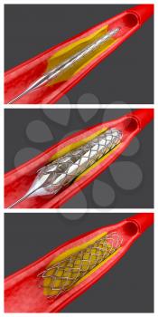 Infarct Clipart