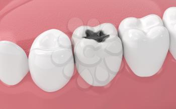 Tooth decay, unhealthy teeth, 3d rendering. Computer digital drawing.