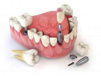 Tooth human implant. Dental concept. Human teeth or dentures. 3d illustration