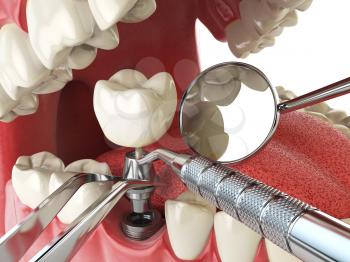 Tooth human implant. Dental implantation concept. Human teeth or dentures anddental tools. 3d illustration