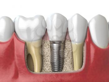 Anatomy of healthy teeth and tooth dental implant in human dentura. 3d illustration