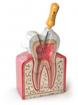 Cross section of Human tooth with endodontic file isolated on white. 3d illustration