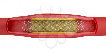 Angioplasty with stent placement, 3d illustration