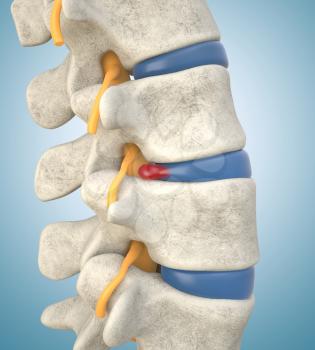 Human lumbar spine model demonstrating herniated disc, pressure nerve root causing back pain. 3D illustration